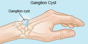 ganglion