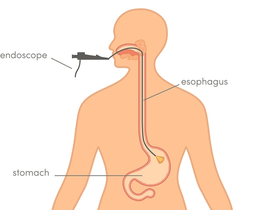 Gastroskopi P Privatklinik Uden Ventetid